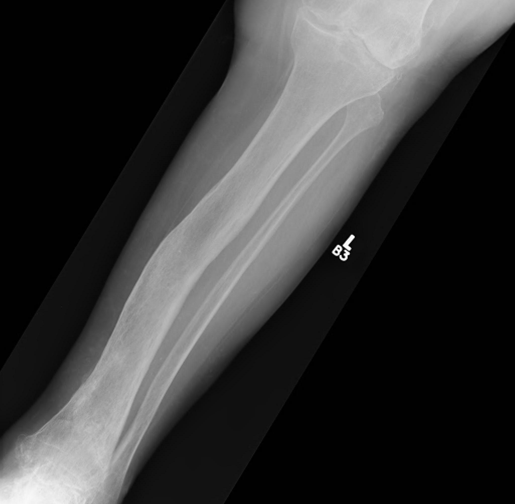 Pagets Tibia